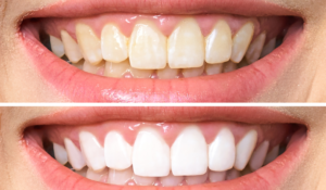 Read more about the article Restore Your Beautiful Grin By Using Best Whitener For Teeth