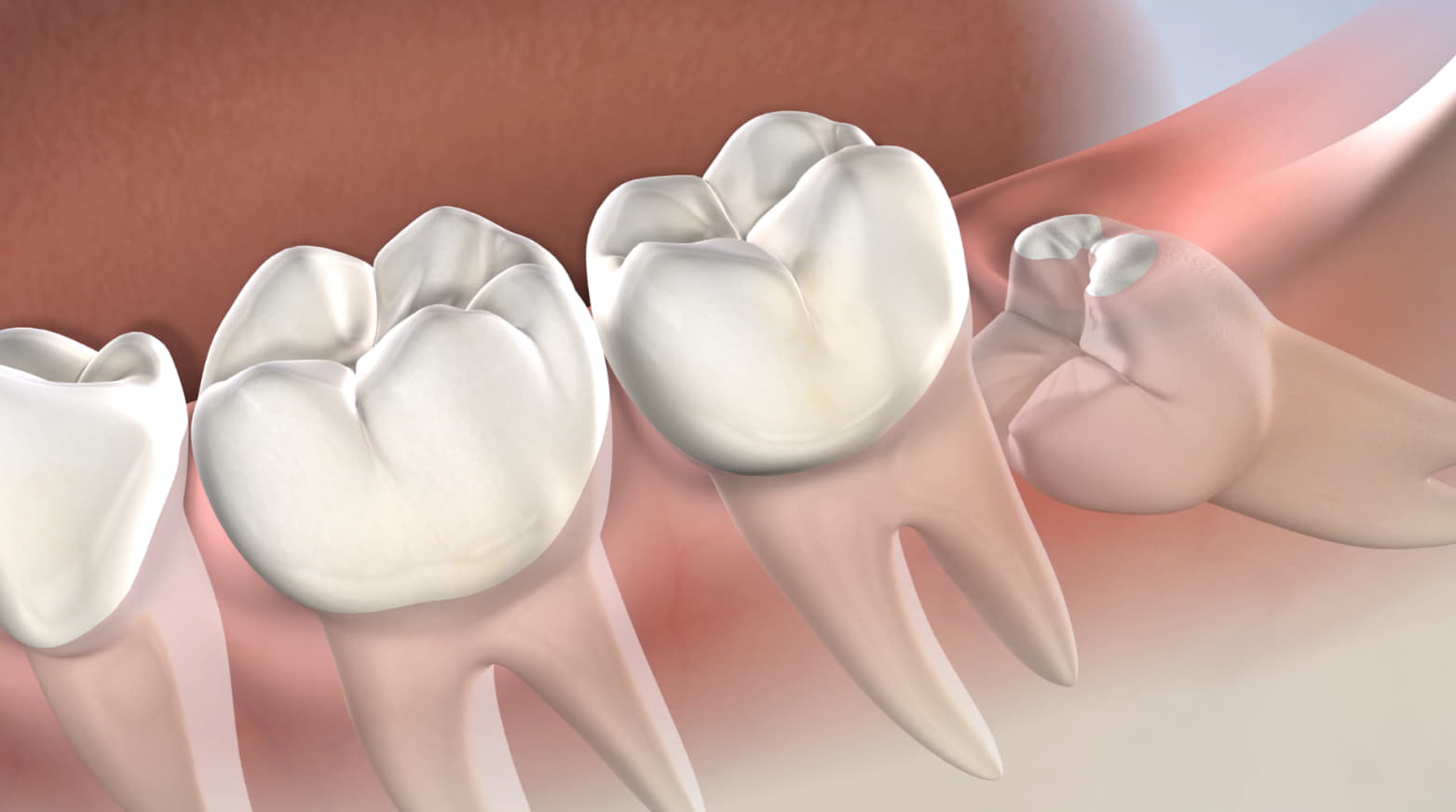 You are currently viewing Timing Wisdom: Knowing When to Opt for Extracting Wisdom Teeth