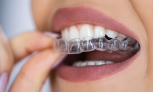 Read more about the article Get Confident Smile With Orthodontic Treatment